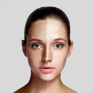 Niacinamide-can-help-decrease-hyperpigmentation-and-age-related-pigmented-spots