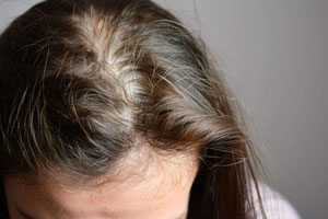 What-is-Alopecia-Areata-biobird