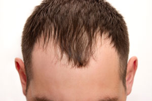 what-is-Androgenetic-Alopecia-biobid