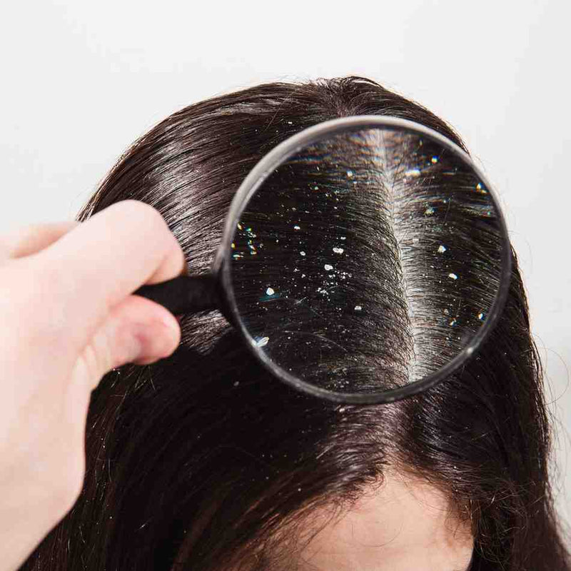 Dandruff Treatment: Causes, Symptoms, Home Remedies & Prevention