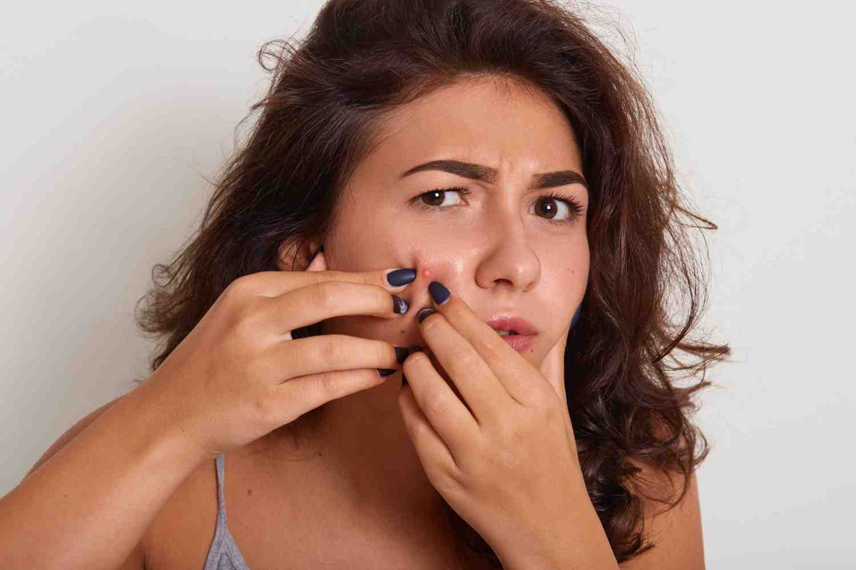 Types of Acne: Causes, Common Types, and Effective Treatments